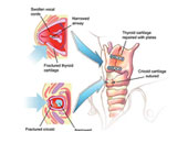 Επιπλοκές θυρεοειδεκτομής: πρόληψη - αντιμετώπιση